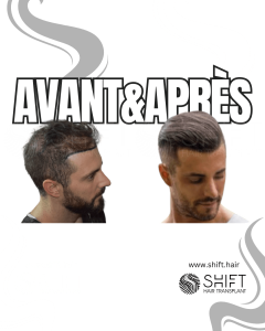 Avant Après de la greffe de cheveux de modèle féminin en Turquie chez SHIFT Hair à Istanbul 01 3