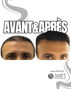 Avant Après de la greffe de cheveux de modèle féminin en Turquie chez SHIFT Hair à Istanbul 02 3