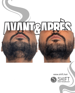 Avant Après de la micropigmentation de la barbe pour le camouflage de densité en Turquie chez SHIFT Hair à Istanbul 01 3