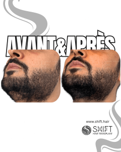 Avant Après de la micropigmentation de la barbe pour le camouflage de densité en Turquie chez SHIFT Hair à Istanbul 02 3