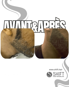 Avant Après de la micropigmentation de la barbe pour le camouflage de densité en Turquie chez SHIFT Hair à Istanbul 03 3