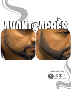 Avant Après de la micropigmentation de la barbe pour le camouflage de densité en Turquie chez SHIFT Hair à Istanbul 04 3
