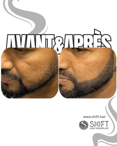 Avant Après de la micropigmentation de la barbe pour le camouflage de densité en Turquie chez SHIFT Hair à Istanbul 05 3