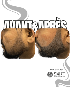 Avant Après de la micropigmentation de la barbe pour le camouflage de densité en Turquie chez SHIFT Hair à Istanbul 07 3