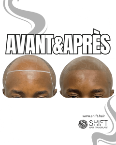 Avant Après de la micropigmentation du cuir chevelu afro pour un look rasé en Turquie chez SHIFT Hair à Istanbul 01 3