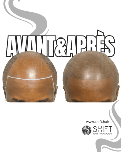 Avant Après de la micropigmentation du cuir chevelu afro pour un look rasé en Turquie chez SHIFT Hair à Istanbul 02 3