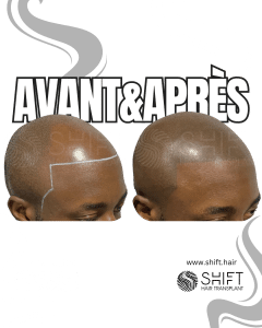 Avant Après de la micropigmentation du cuir chevelu afro pour un look rasé en Turquie chez SHIFT Hair à Istanbul 04 3