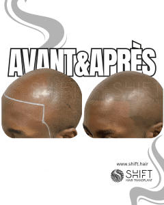 Avant Après de la micropigmentation du cuir chevelu afro pour un look rasé en Turquie chez SHIFT Hair à Istanbul 05 3