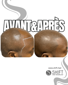 Avant Après de la micropigmentation du cuir chevelu afro pour un look rasé en Turquie chez SHIFT Hair à Istanbul 06 3