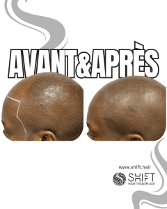Avant Après de la micropigmentation du cuir chevelu afro pour un look rasé en Turquie chez SHIFT Hair à Istanbul 07 3
