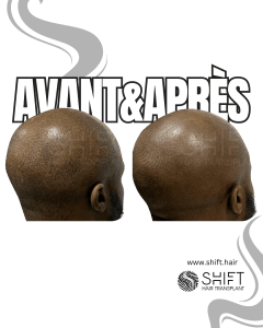 Avant Après de la micropigmentation du cuir chevelu afro pour un look rasé en Turquie chez SHIFT Hair à Istanbul 08 3