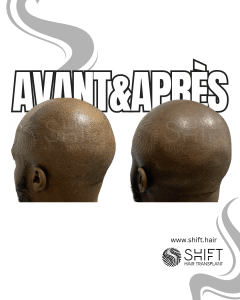 Avant Après de la micropigmentation du cuir chevelu afro pour un look rasé en Turquie chez SHIFT Hair à Istanbul 09 3