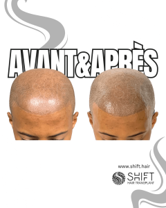 Avant Après de la micropigmentation du cuir chevelu afro pour un look rasé en Turquie chez SHIFT Hair à Istanbul 13 3
