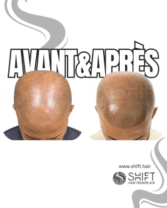 Avant Après de la micropigmentation du cuir chevelu afro pour un look rasé en Turquie chez SHIFT Hair à Istanbul 14 3