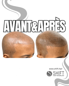 Avant Après de la micropigmentation du cuir chevelu afro pour un look rasé en Turquie chez SHIFT Hair à Istanbul 15 3