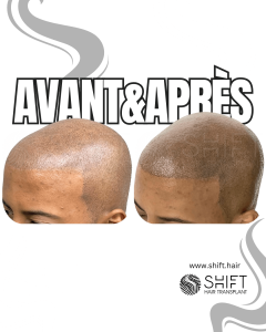 Avant Après de la micropigmentation du cuir chevelu afro pour un look rasé en Turquie chez SHIFT Hair à Istanbul 16 3