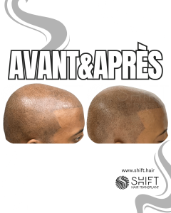 Avant Après de la micropigmentation du cuir chevelu afro pour un look rasé en Turquie chez SHIFT Hair à Istanbul 17 3