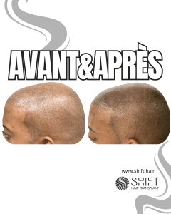 Avant Après de la micropigmentation du cuir chevelu afro pour un look rasé en Turquie chez SHIFT Hair à Istanbul 18 3