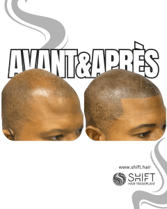 Avant Après de la micropigmentation du cuir chevelu afro pour un look rasé en Turquie chez SHIFT Hair à Istanbul 20 3