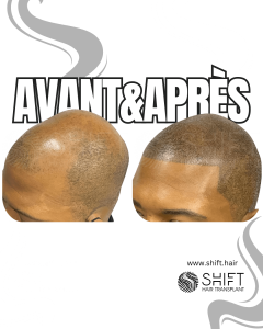 Avant Après de la micropigmentation du cuir chevelu afro pour un look rasé en Turquie chez SHIFT Hair à Istanbul 21 3
