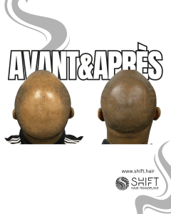 Avant Après de la micropigmentation du cuir chevelu afro pour un look rasé en Turquie chez SHIFT Hair à Istanbul 22 3