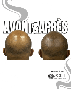 Avant Après de la micropigmentation du cuir chevelu afro pour un look rasé en Turquie chez SHIFT Hair à Istanbul 23 3