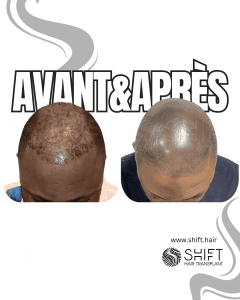 Avant Après de la micropigmentation du cuir chevelu afro pour un look rasé en Turquie chez SHIFT Hair à Istanbul 25 3