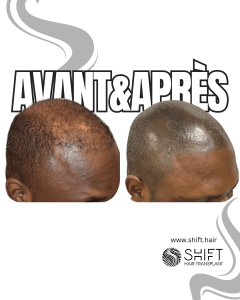 Avant Après de la micropigmentation du cuir chevelu afro pour un look rasé en Turquie chez SHIFT Hair à Istanbul 26 3