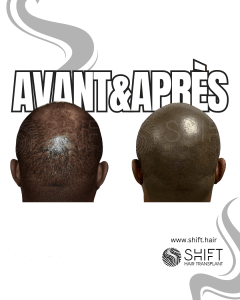Avant Après de la micropigmentation du cuir chevelu afro pour un look rasé en Turquie chez SHIFT Hair à Istanbul 28 3
