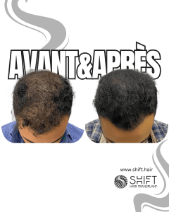 Avant Après de la micropigmentation du cuir chevelu pour le camouflage de densité en Turquie chez SHIFT Hair à Istanbul 01 3