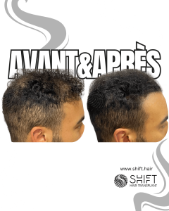 Avant Après de la micropigmentation du cuir chevelu pour le camouflage de densité en Turquie chez SHIFT Hair à Istanbul 03 3