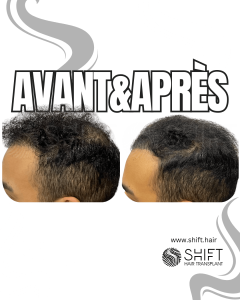 Avant Après de la micropigmentation du cuir chevelu pour le camouflage de densité en Turquie chez SHIFT Hair à Istanbul 04 3