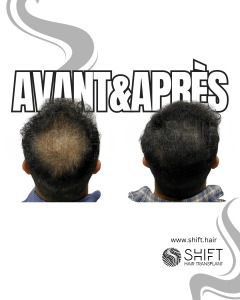 Avant Après de la micropigmentation du cuir chevelu pour le camouflage de densité en Turquie chez SHIFT Hair à Istanbul 05 3