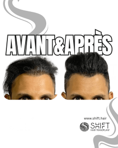 Avant Après de la micropigmentation du cuir chevelu pour le camouflage de densité en Turquie chez SHIFT Hair à Istanbul 06 3