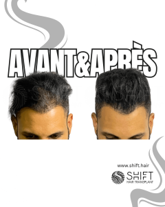 Avant Après de la micropigmentation du cuir chevelu pour le camouflage de densité en Turquie chez SHIFT Hair à Istanbul 07 3