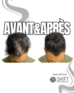 Avant Après de la micropigmentation du cuir chevelu pour le camouflage de densité en Turquie chez SHIFT Hair à Istanbul 08 3