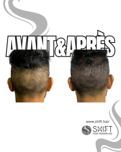 Avant Après de la micropigmentation du cuir chevelu pour le camouflage de densité en Turquie chez SHIFT Hair à Istanbul 15 3
