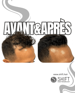 Avant Après de la micropigmentation du cuir chevelu pour le camouflage de densité en Turquie chez SHIFT Hair à Istanbul 16 3