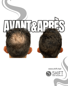 Avant Après de la micropigmentation du cuir chevelu pour le camouflage de densité en Turquie chez SHIFT Hair à Istanbul 17 3