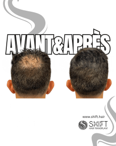 Avant Après de la micropigmentation du cuir chevelu pour le camouflage de densité en Turquie chez SHIFT Hair à Istanbul 18 3