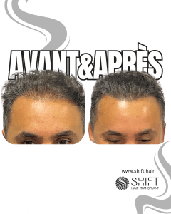 Avant Après de la micropigmentation du cuir chevelu pour le camouflage de densité en Turquie chez SHIFT Hair à Istanbul 19 3