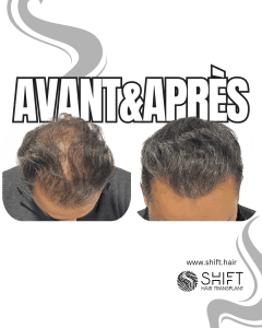 Avant Après de la micropigmentation du cuir chevelu pour le camouflage de densité en Turquie chez SHIFT Hair à Istanbul 20 3