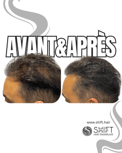 Avant Après de la micropigmentation du cuir chevelu pour le camouflage de densité en Turquie chez SHIFT Hair à Istanbul 22 3