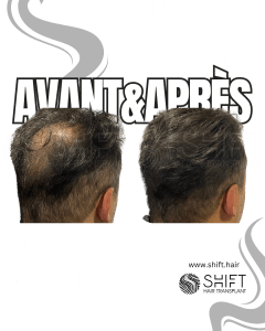 Avant Après de la micropigmentation du cuir chevelu pour le camouflage de densité en Turquie chez SHIFT Hair à Istanbul 23 3
