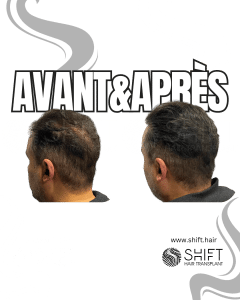Avant Après de la micropigmentation du cuir chevelu pour le camouflage de densité en Turquie chez SHIFT Hair à Istanbul 24 3