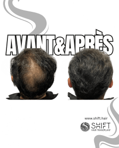Avant Après de la micropigmentation du cuir chevelu pour le camouflage de densité en Turquie chez SHIFT Hair à Istanbul 25 3