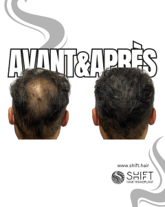 Avant Après de la micropigmentation du cuir chevelu pour le camouflage de densité en Turquie chez SHIFT Hair à Istanbul 26 3