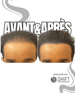 Avant Après de la micropigmentation du cuir chevelu pour le camouflage de densité en Turquie chez SHIFT Hair à Istanbul 27 3