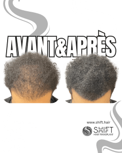 Avant Après de la micropigmentation du cuir chevelu pour le camouflage de densité en Turquie chez SHIFT Hair à Istanbul 28 3