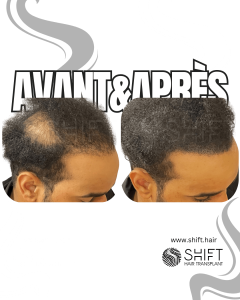 Avant Après de la micropigmentation du cuir chevelu pour le camouflage de densité en Turquie chez SHIFT Hair à Istanbul 29 3